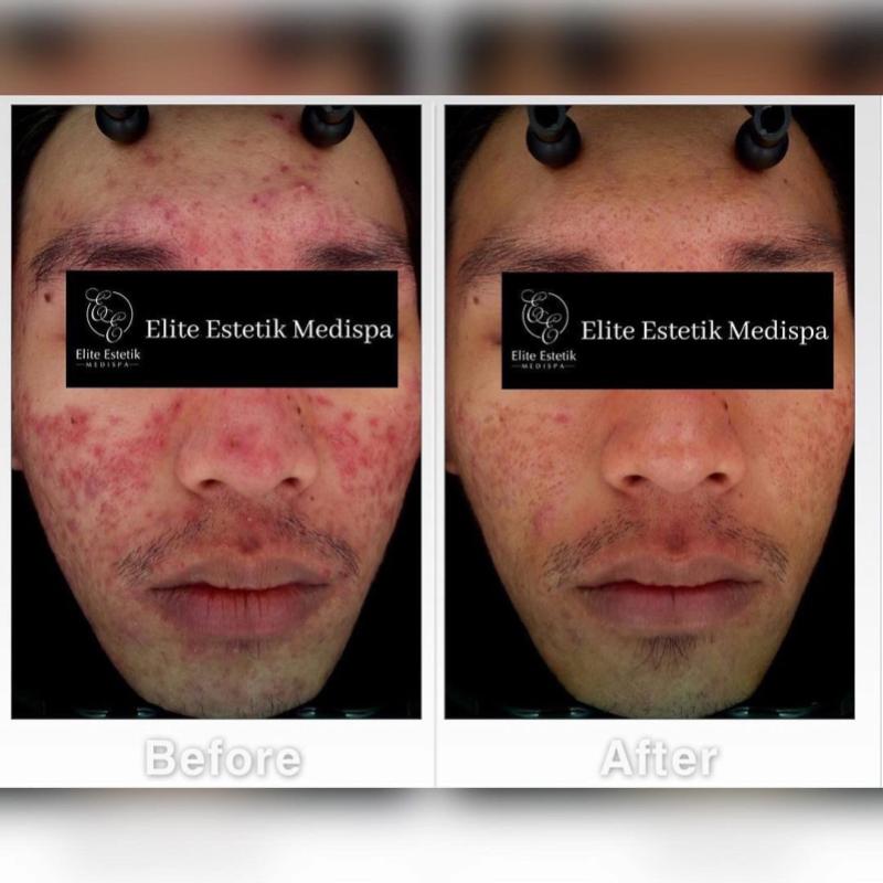 10 Pusat Rawatan Muka Terbaik Di Sarawak 2025 9 Elite-Estetik-Medispa-