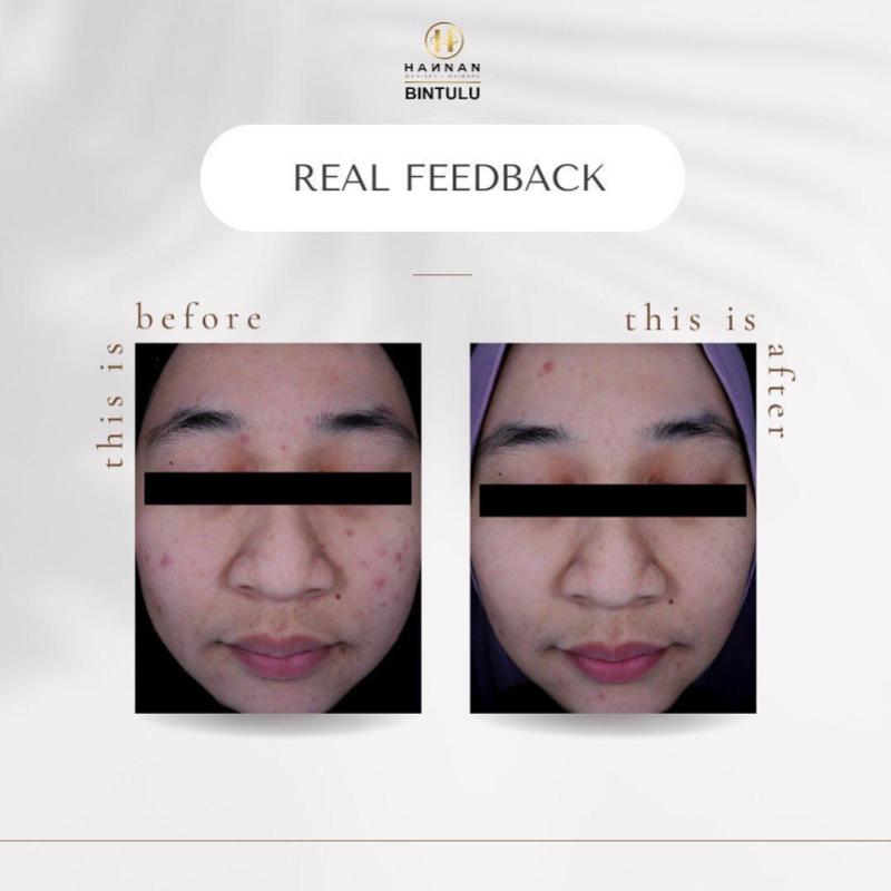 10 Pusat Rawatan Muka Terbaik Di Sarawak 2025 3 Hannan-Medispa-