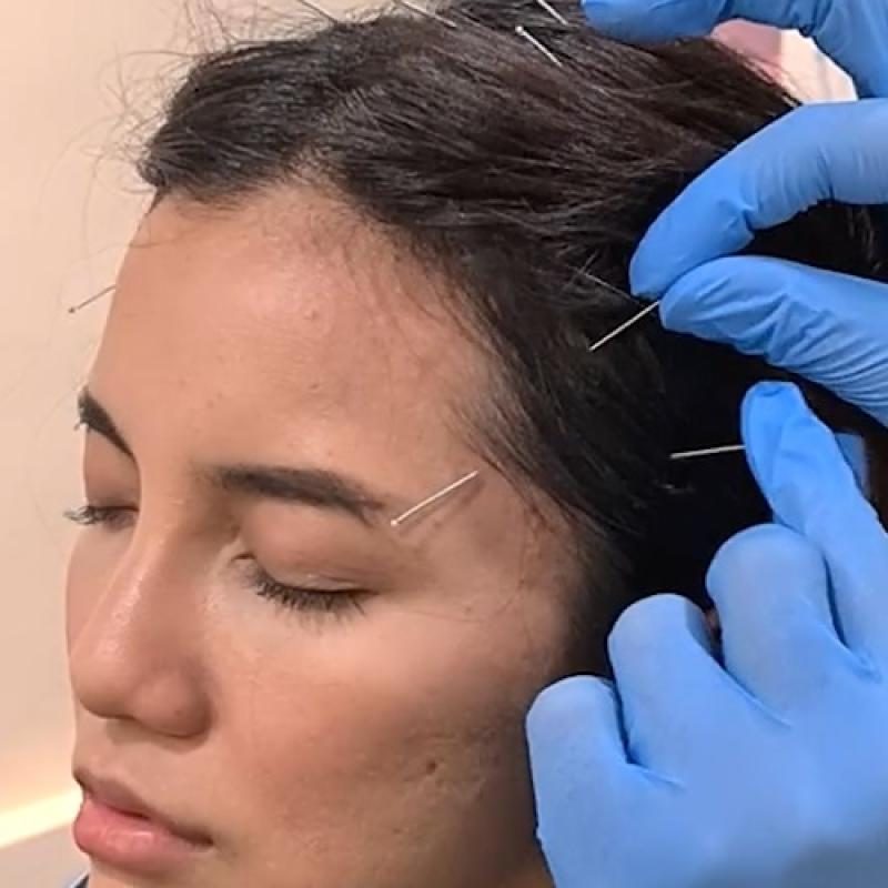 10 Perkhidmatan Akupunktur Terbaik di KL & Selangor 2025 7 AcuHealing--