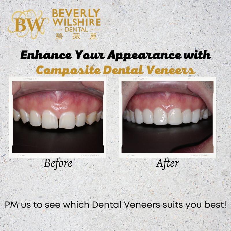 <strong>10 Klinik Veneer Terbaik di Malaysia 2025</strong> 11 Beverly-Wilshire-Dental-Kuala-Lumpur--