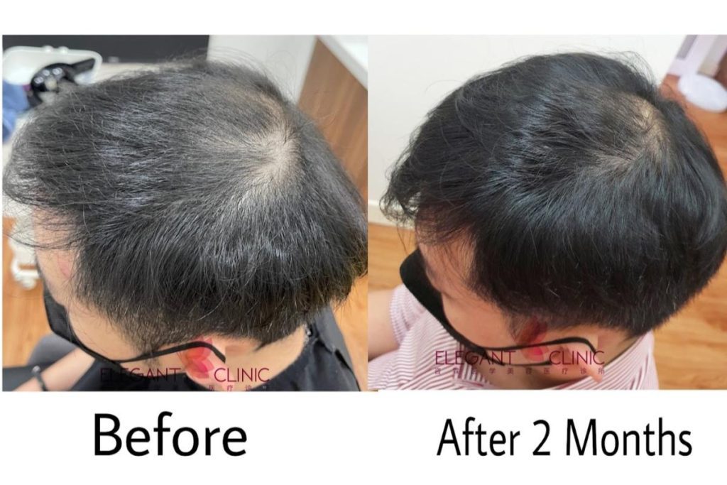 <strong>10 Pusat Rawatan Rambut Gugur Terbaik di Kuala Lumpur 2025</strong> 11 Elegant-Clinic-