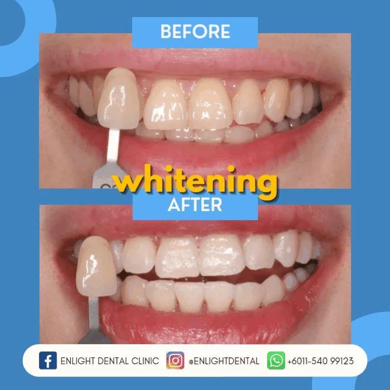 <strong>Top 10 Best Teeth Whitening Dentists in Sabah 2025</strong> 19 Enlight-Dental--resize-image