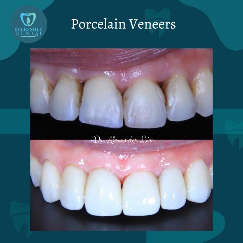 <strong>Top 10 Best Clinics For Veneers in Penang 2025</strong> 17 Eversmile-Dental-Penang--