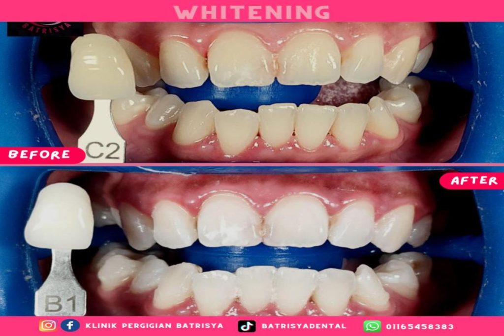 <strong>Top 10 Best Teeth Whitening Dentists in Melaka 2026</strong> 21 Klinik-Pergigian-Batrisya-Sdn-Bhd--resize-image