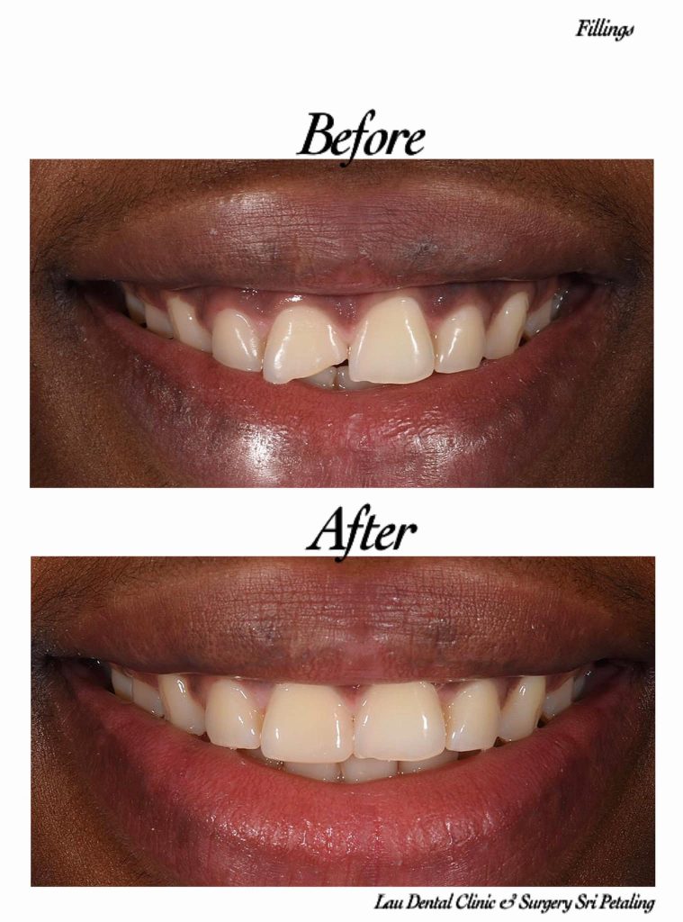 <strong>10 Klinik Veneer Terbaik di Malaysia 2025</strong> 5 Lau-Dental-Clinic-Surgery-Sri-Petaling--