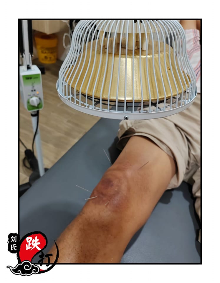 Top 10 Best Acupuncture Services in Melaka 2025 13 Low-TCM-Orthopedic-Acupuncture-Tuina-