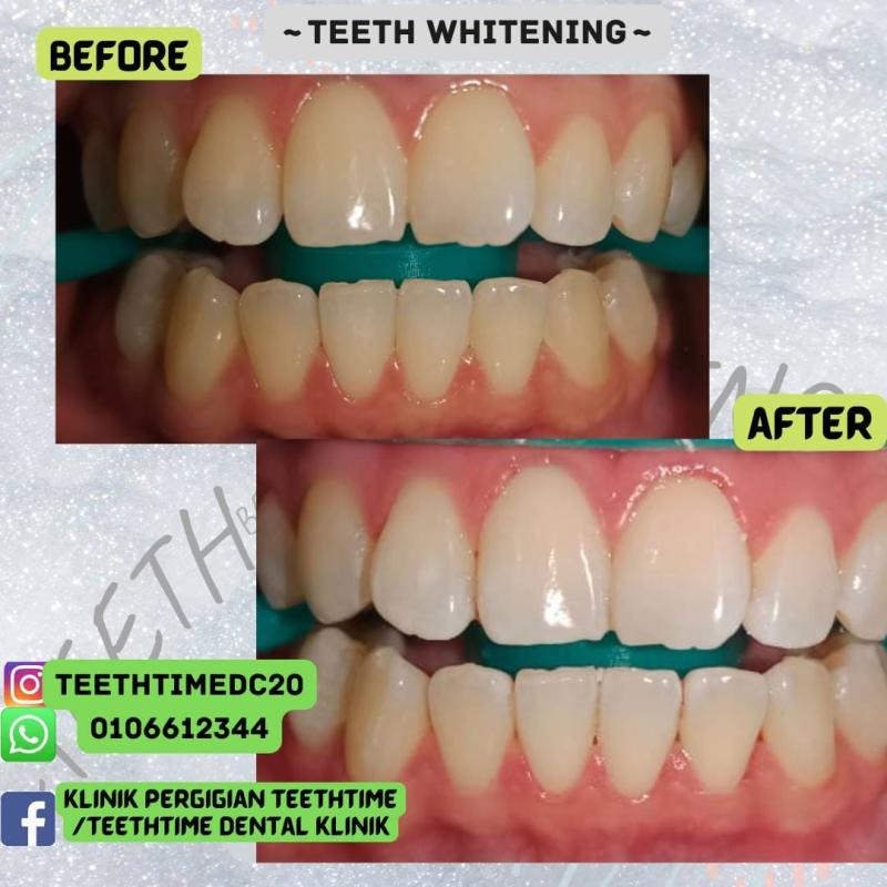 <strong>Top 10 Best Teeth Whitening Dentists in Sabah 2025</strong> 15 Teethtime-Dental-Clinic--resize-image