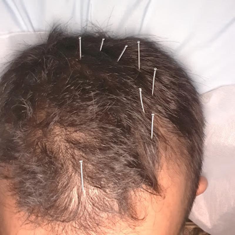 10 Perkhidmatan Akupunktur Terbaik di KL & Selangor 2025 20 The-Tole-Acupuncture-Herbal-Medical-Centre-