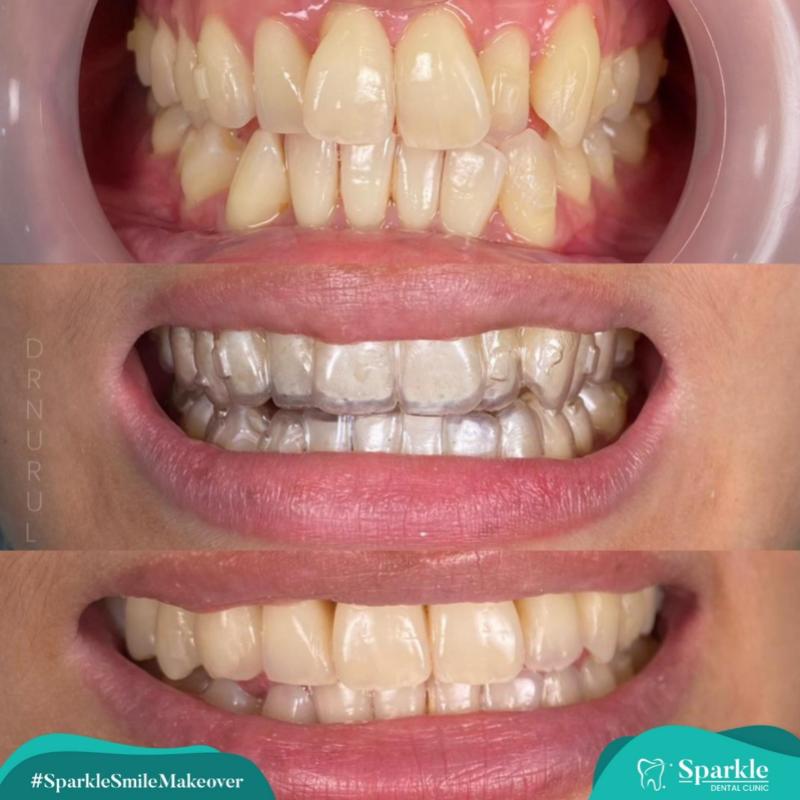 Top 8 Best Clear Braces in Malaysia 2025 7 Klinik Pergigian Sparkle 1