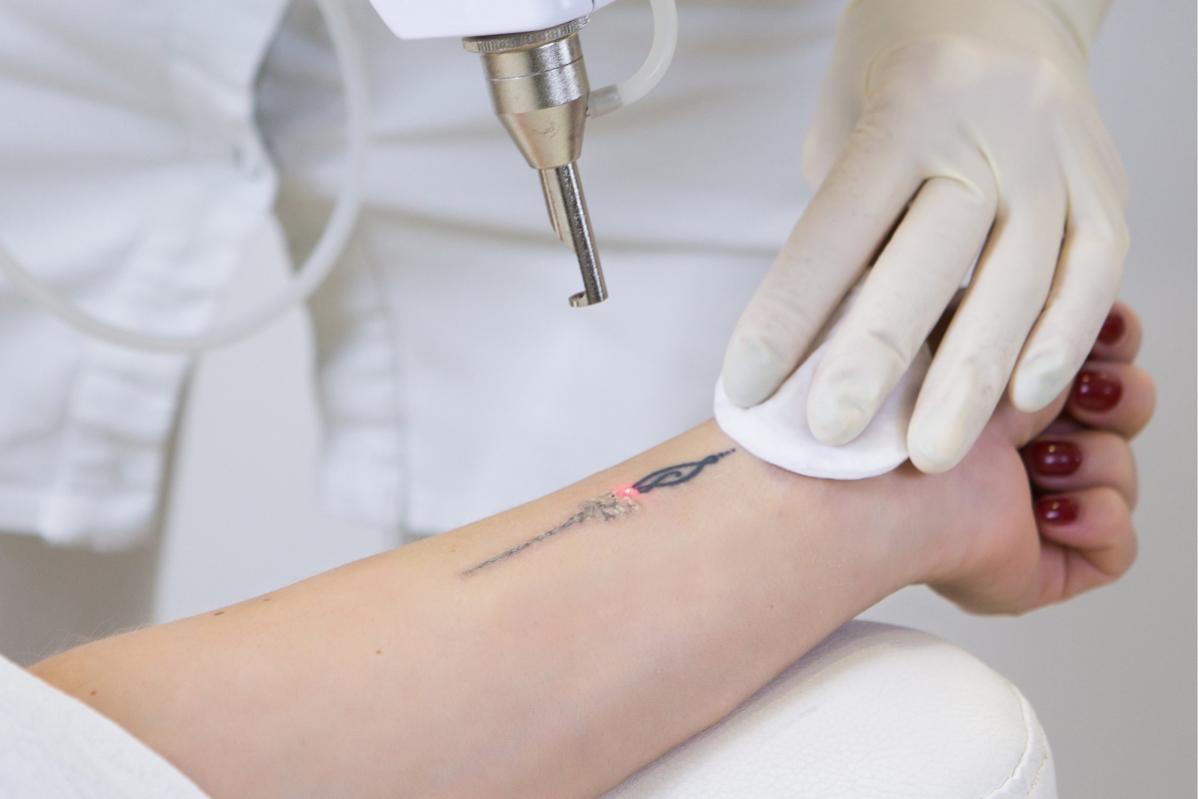 Top 10 Best Tattoo Removal Clinics in Penang 2025 21 IDOS Clinic 1