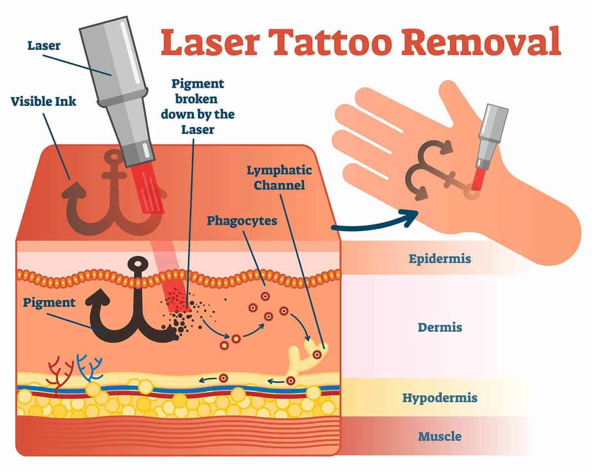 Top 10 Best Tattoo Removal Clinics in Penang 2025 1 Laser Tattoo Removal