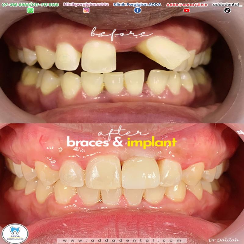 10 Klinik Pergigian Kosmetik Terbaik di Johor 2025 7 Klinik Pergigian Adda 3