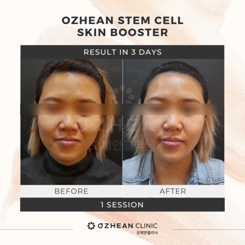 10 Tempat Terbaik Untuk Rawatan Stem Cell di KL & Selangor 2025 17 Stem cell facial treatment improves skin elasticity and supports cellular repair