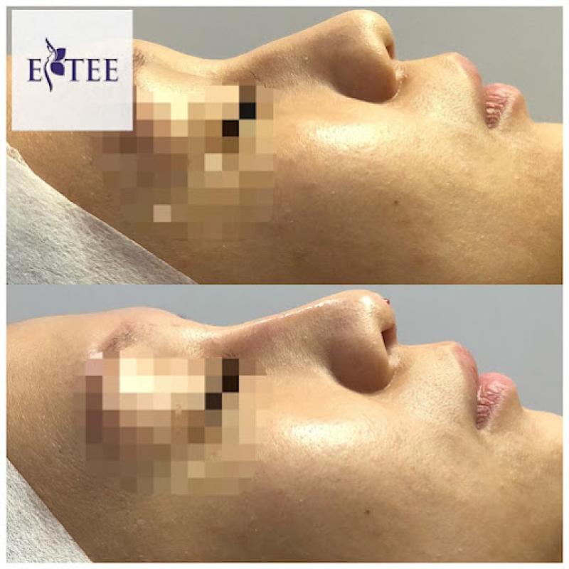 10 Tempat Terbaik Untuk Rawatan Stem Cell di Pulau Pinang 2025 15 Stem cell facial treatment promotes cell repair