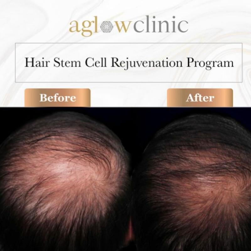 10 Tempat Terbaik Untuk Rawatan Stem Cell di Johor 2025 13 Stem cell treatment rejuvenate existing cells and reduce hair loss