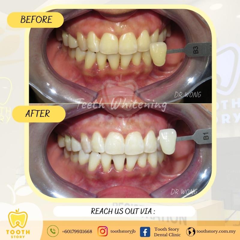 10 Klinik Pergigian Kosmetik Terbaik di Johor 2025 15 Tooth Story Dental Clinic 1 1