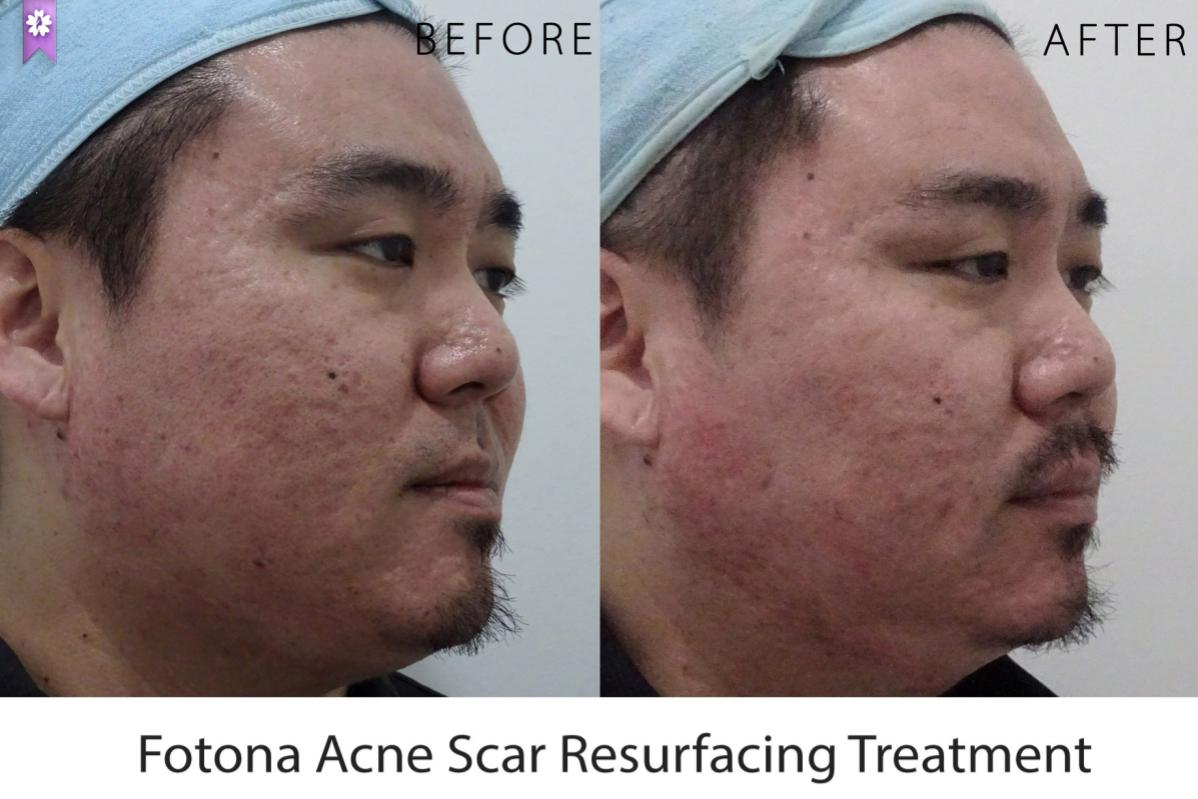 Top 10 Best Acne Scar Treatment Clinics in Johor 2025 17 Beau Hans Clinic 3