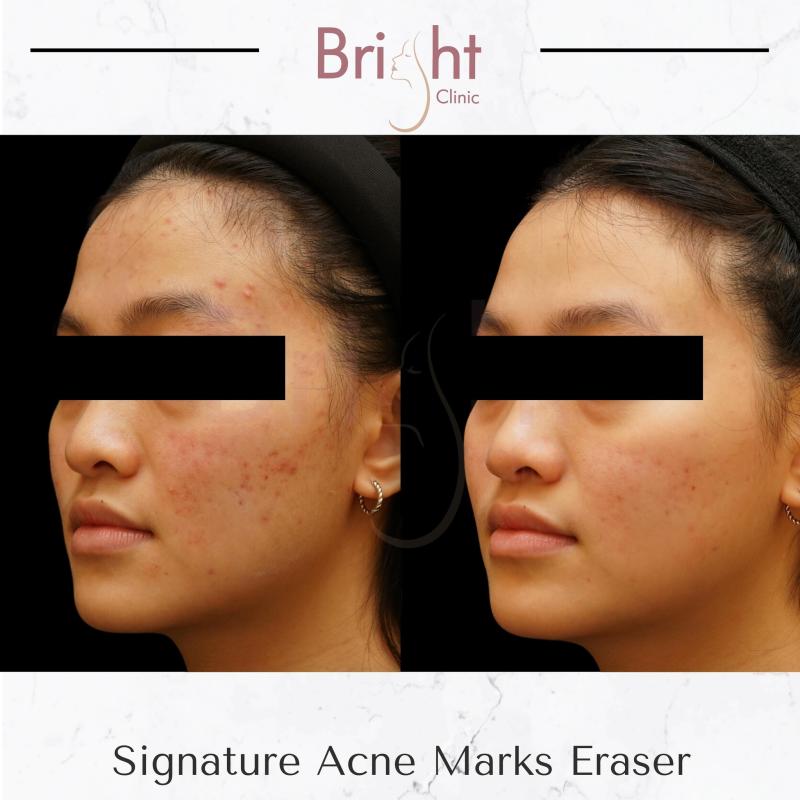 10 Klinik Rawatan Parut Jerawat Terbaik di Malaysia 2025 5 Bright Clinic 1