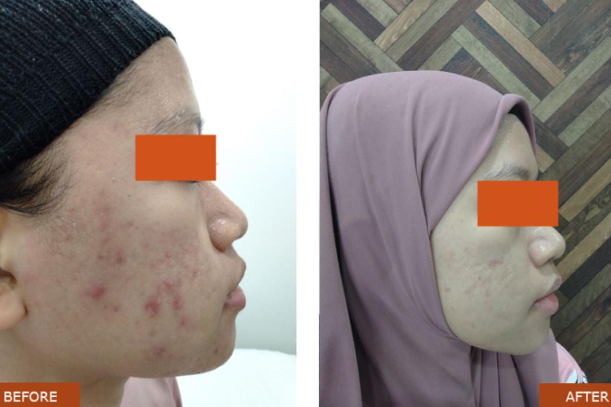 Top 10 Best Acne Scar Treatment Clinics in Johor 2025 21 Dermed Clinic 1