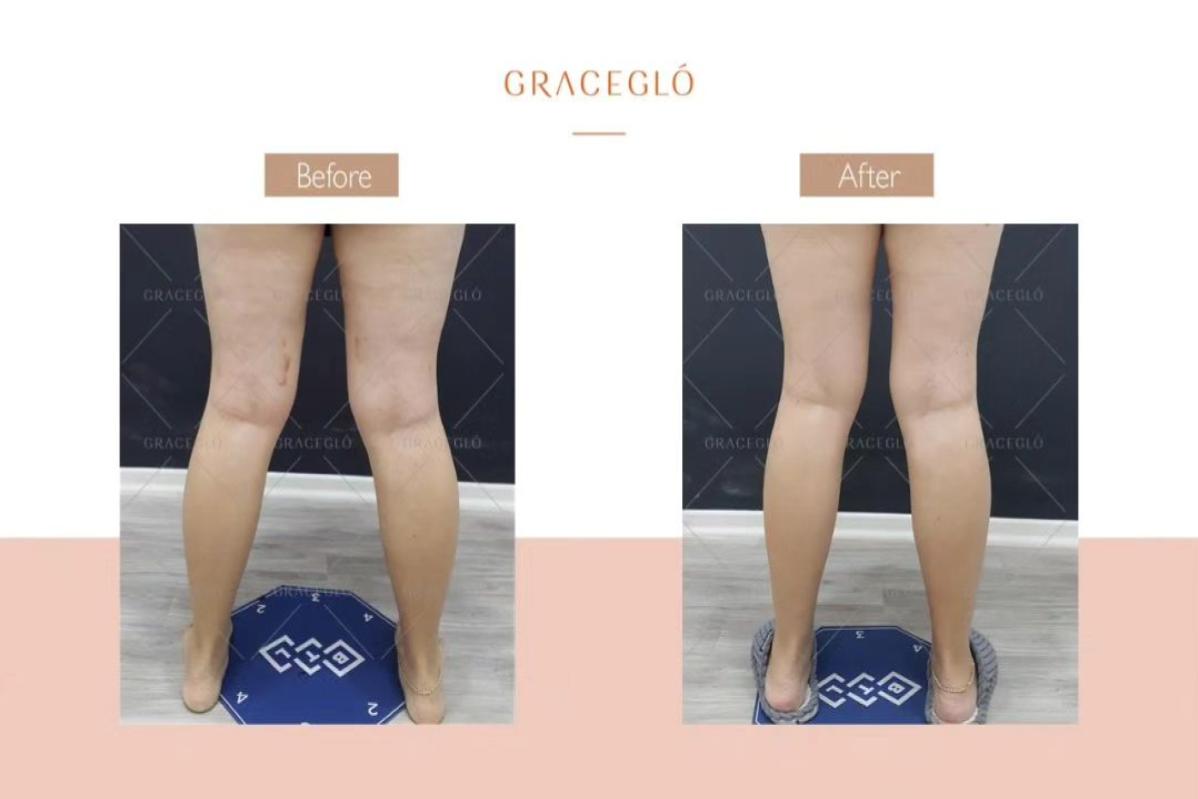 Top 10 Best Cellulite Treatment Clinics in Johor 2025 17 Graceglo 1