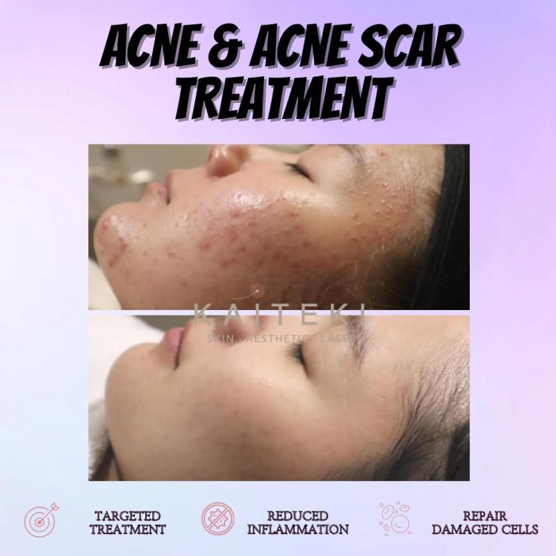 10 Klinik Rawatan Parut Jerawat Terbaik di Malaysia 2025 19 Kaiteki Clinic 1