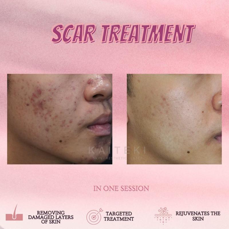 Top 10 Best Acne Scar Treatment Clinics in Johor 2025 9 Kaiteki Clinic 3