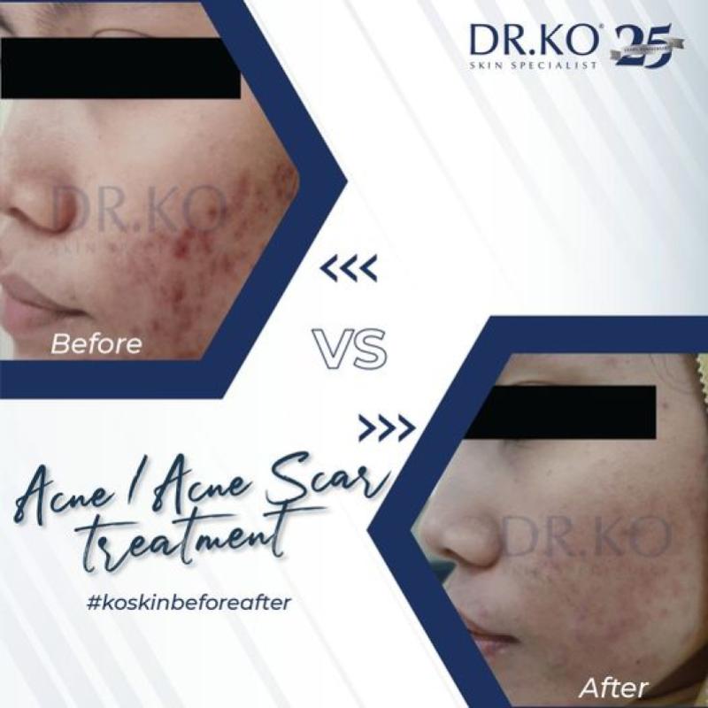 Top 10 Best Acne Scar Treatment Clinics in Johor 2025 13 Klinik Dr Ko 3