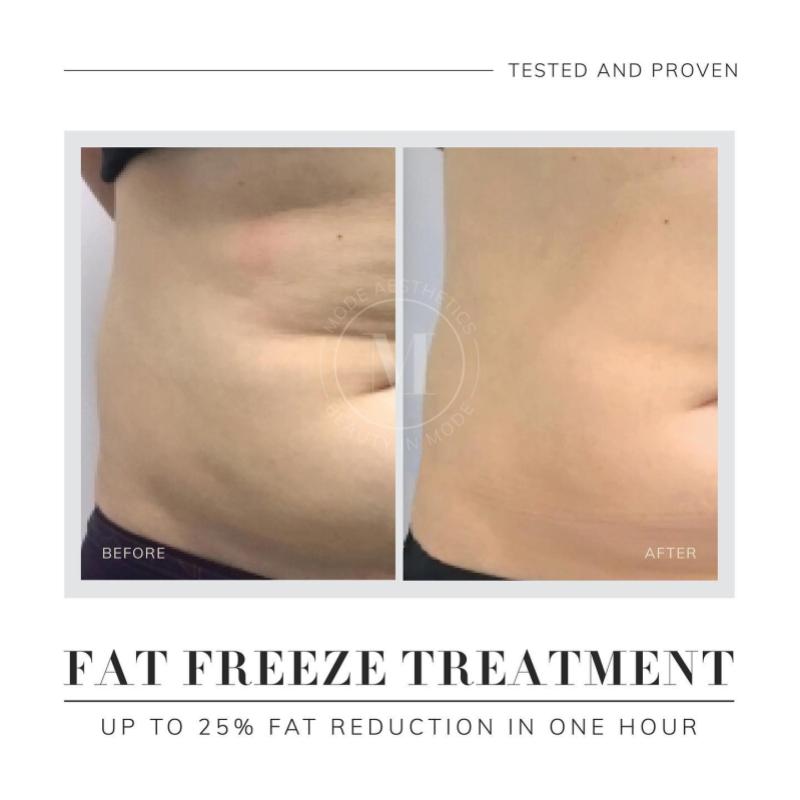 Top 10 Best Fat Freezing Treatment Clinics in Penang 2025 15 MODE Aesthetics 1