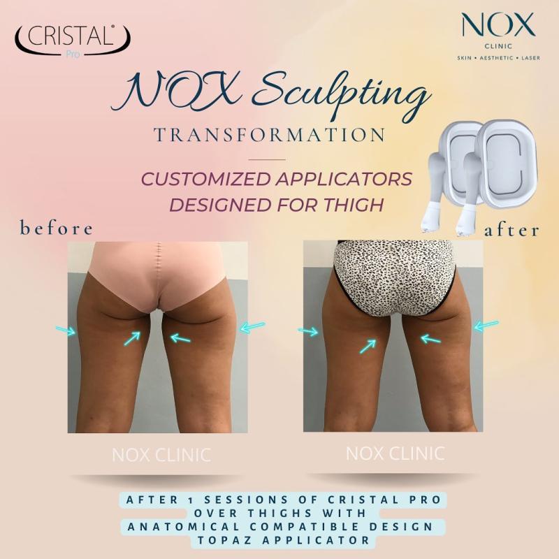 Top 10 Best Cellulite Treatment Clinics in Johor 2025 19 NOX Clinic 1