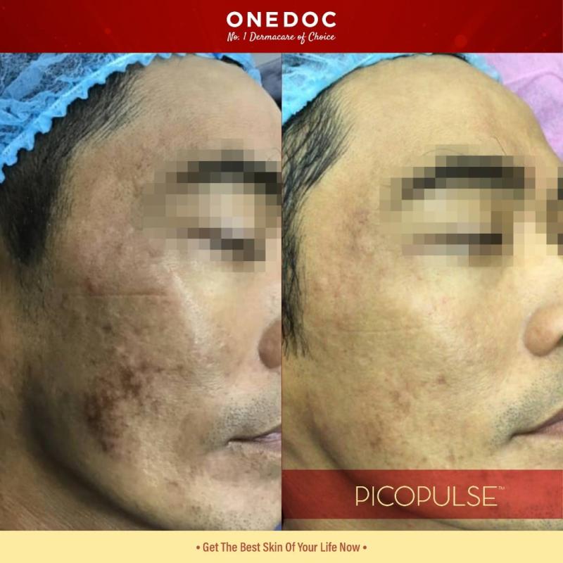 10 Klinik Rawatan Parut Jerawat Terbaik di Malaysia 2025 3 One Doc 1