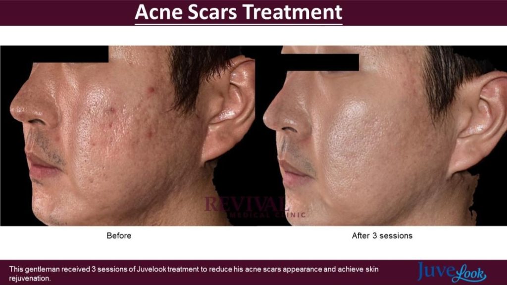 Top 10 Best Acne Scar Treatment Clinics in Johor 2025 7 Revival Medical Clinic 1 e1725513537108