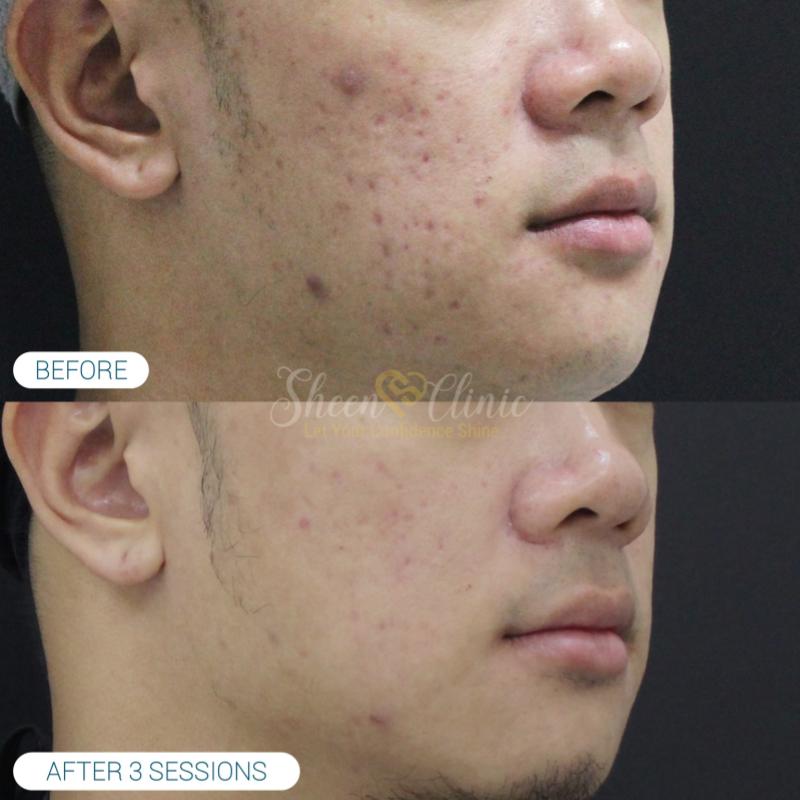 10 Klinik Rawatan Parut Jerawat Terbaik di KL & Selangor 2025 19 Sheen Clinic 1 1