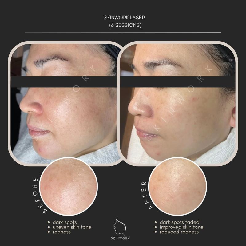 Top 10 Best Acne Scar Treatment Clinics in Johor 2025 3 Skinwork 1