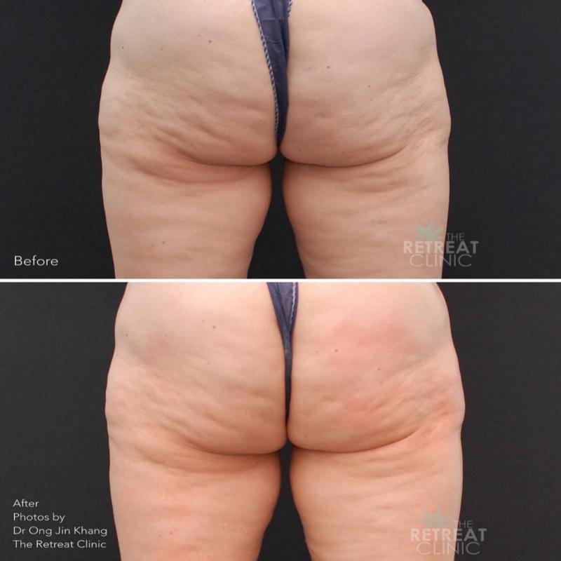 10 Klinik Rawatan Selulit Terbaik di Malaysia 2025 19 The Retreat Clinic 2 1