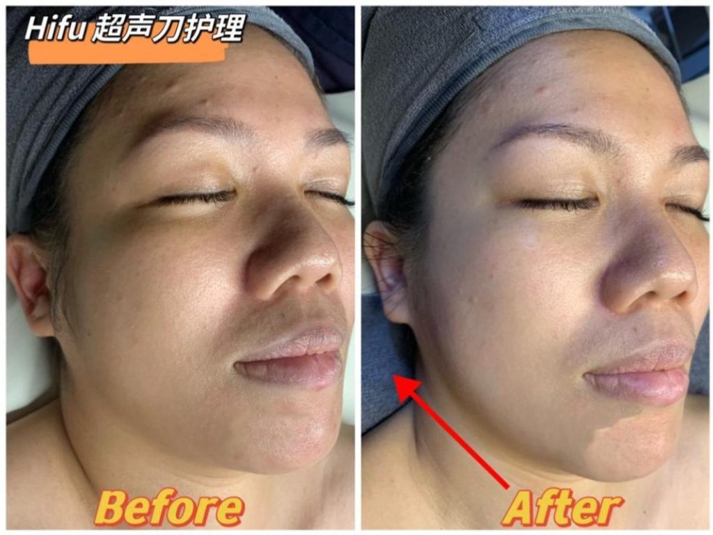 Top 10 Best HIFU Treatment Clinics in Johor 2025 3 Eva Beauty Concept 2 e1727836296816