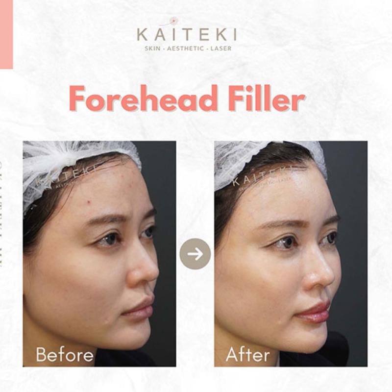 Top 10 Best Dermal Filler Clinics in KL & Selangor 2025 9 Kaiteki Clinic 6