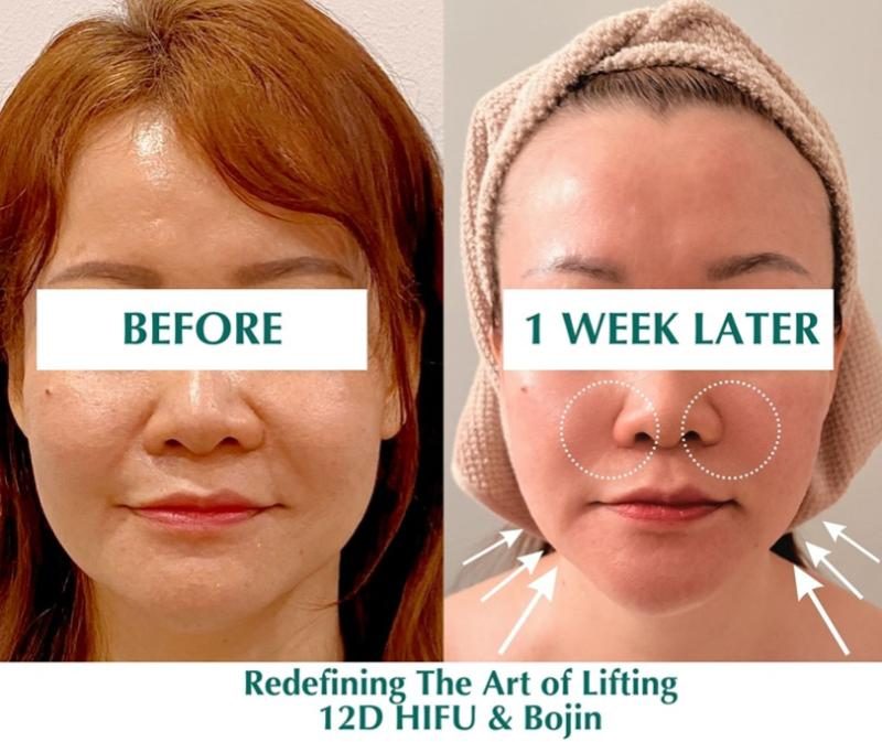 Top 10 Best HIFU Treatment Clinics in Penang 2025 5 Medi Beaute 2 e1727832235740