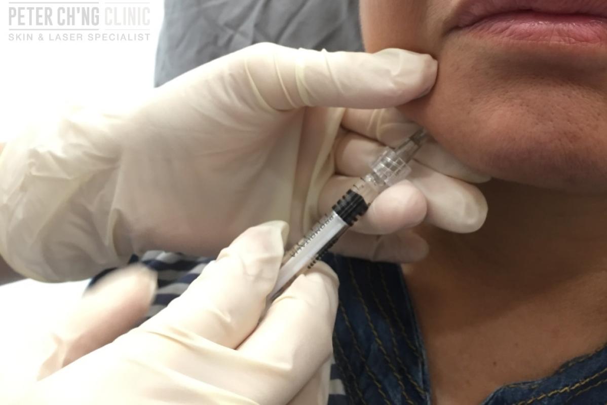 Top 10 Best Dermal Filler Clinics in KL & Selangor 2025 21 Peter Chng Clinic 1 1