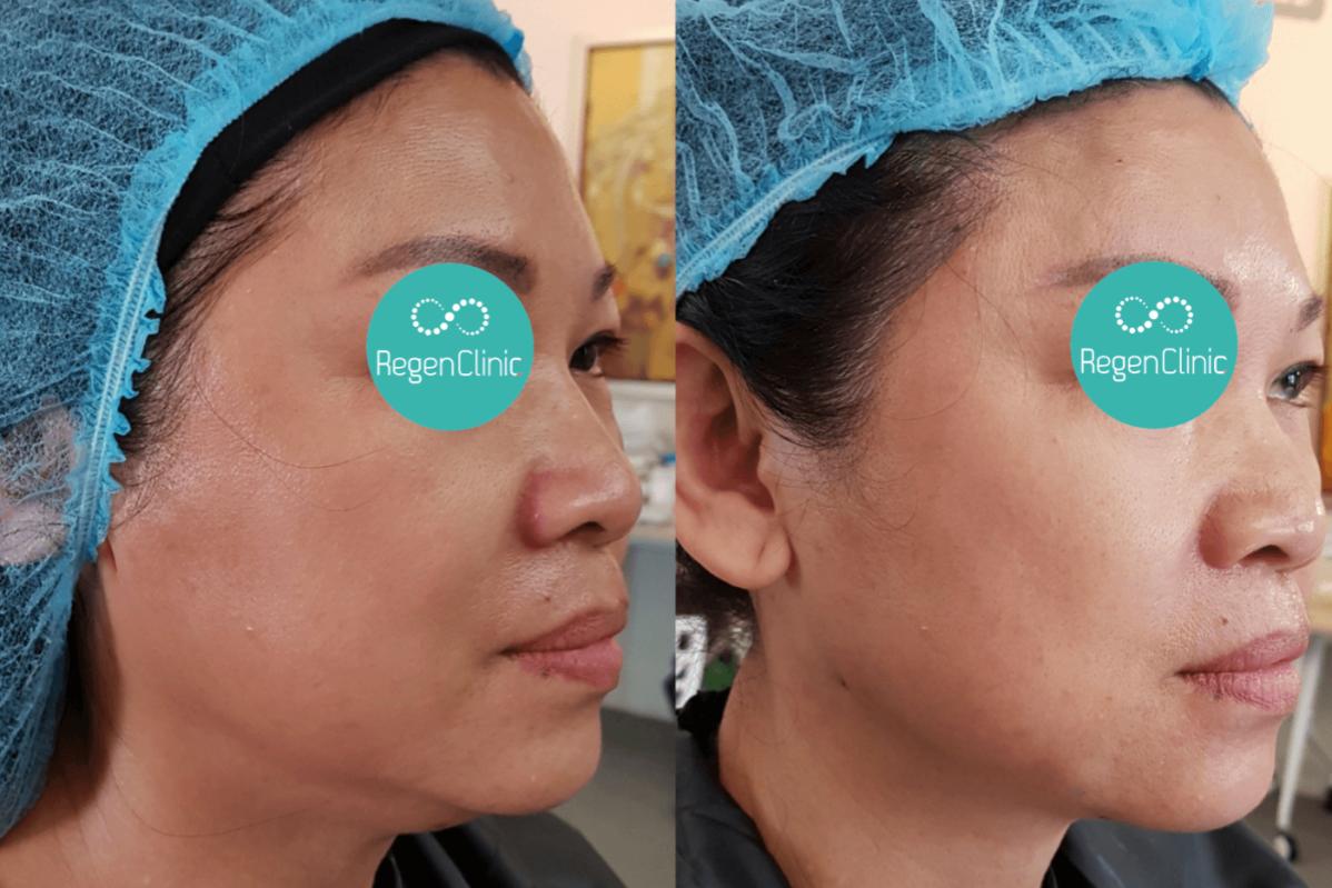 10 Klinik Botox Terbaik di Penang 2025 13 Regen Clinic 5